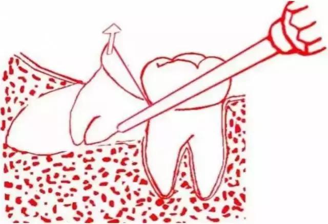 智齿的治疗过程,智齿要上下成对拔除吗