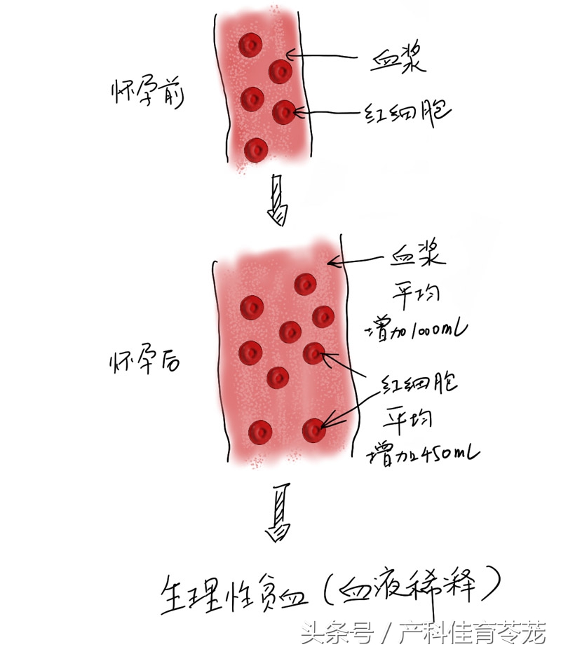怀孕了有点贫血怎么办,怀孕缺铁性贫血