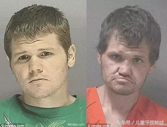 如何从牙齿上判断小孩是否铅中毒,大人口腔细菌对宝宝危害真实案例