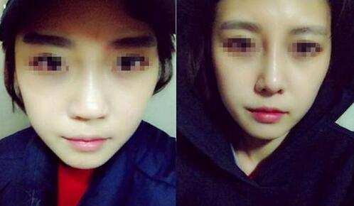 鼻子做假体多久才能恢复正常,鼻子做假体增生了怎么办