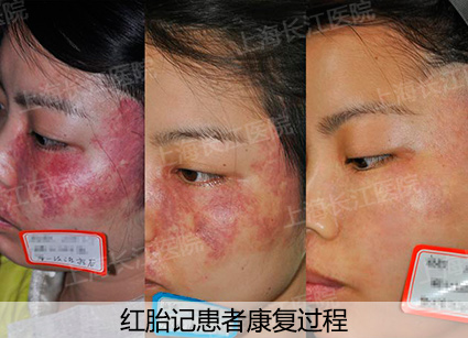 为什么红胎记会突出皮肤表面,光动力治红胎记失败