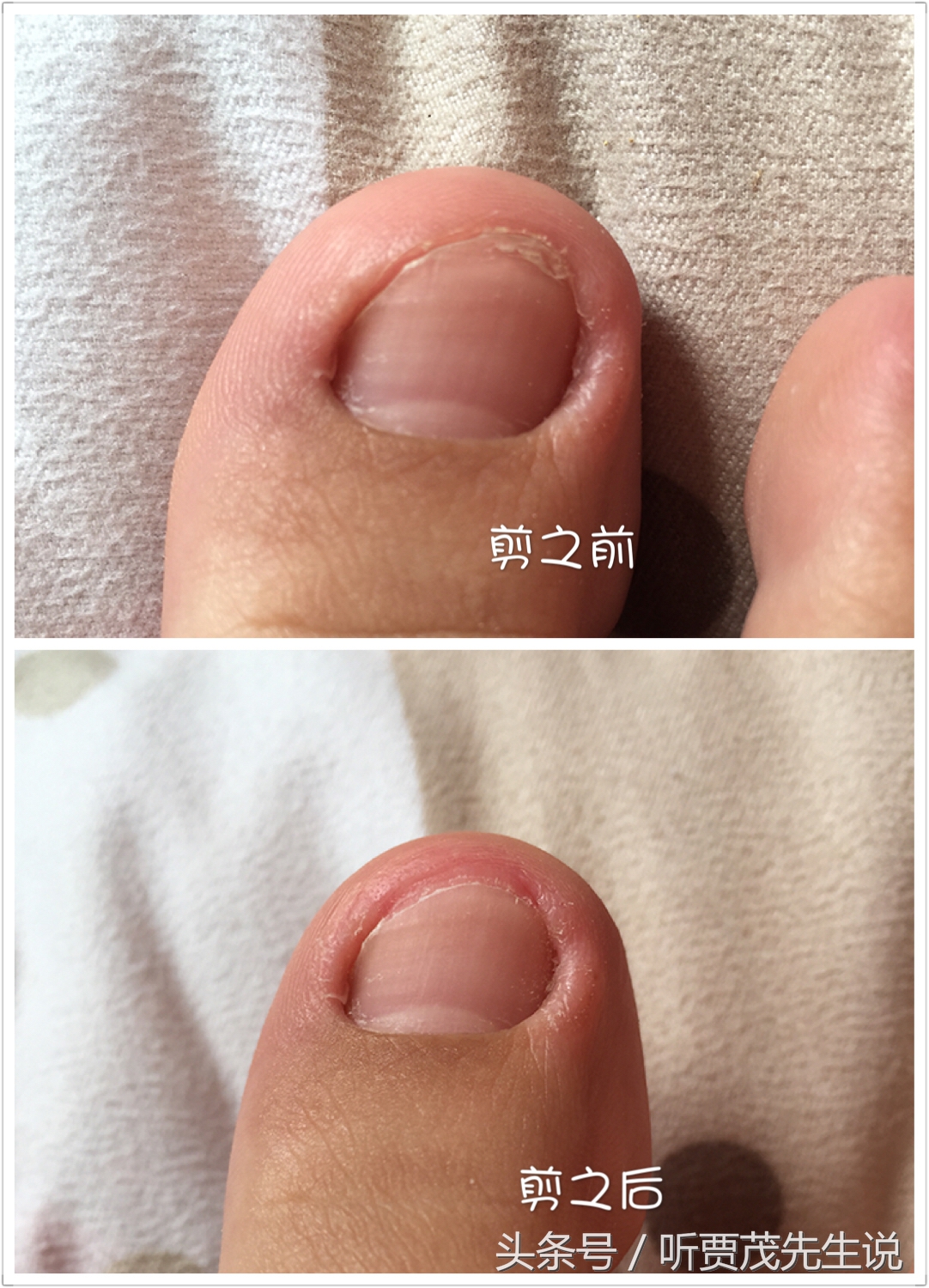 脚趾甲长进肉里什么原因,脚趾甲长进肉是怎么回事