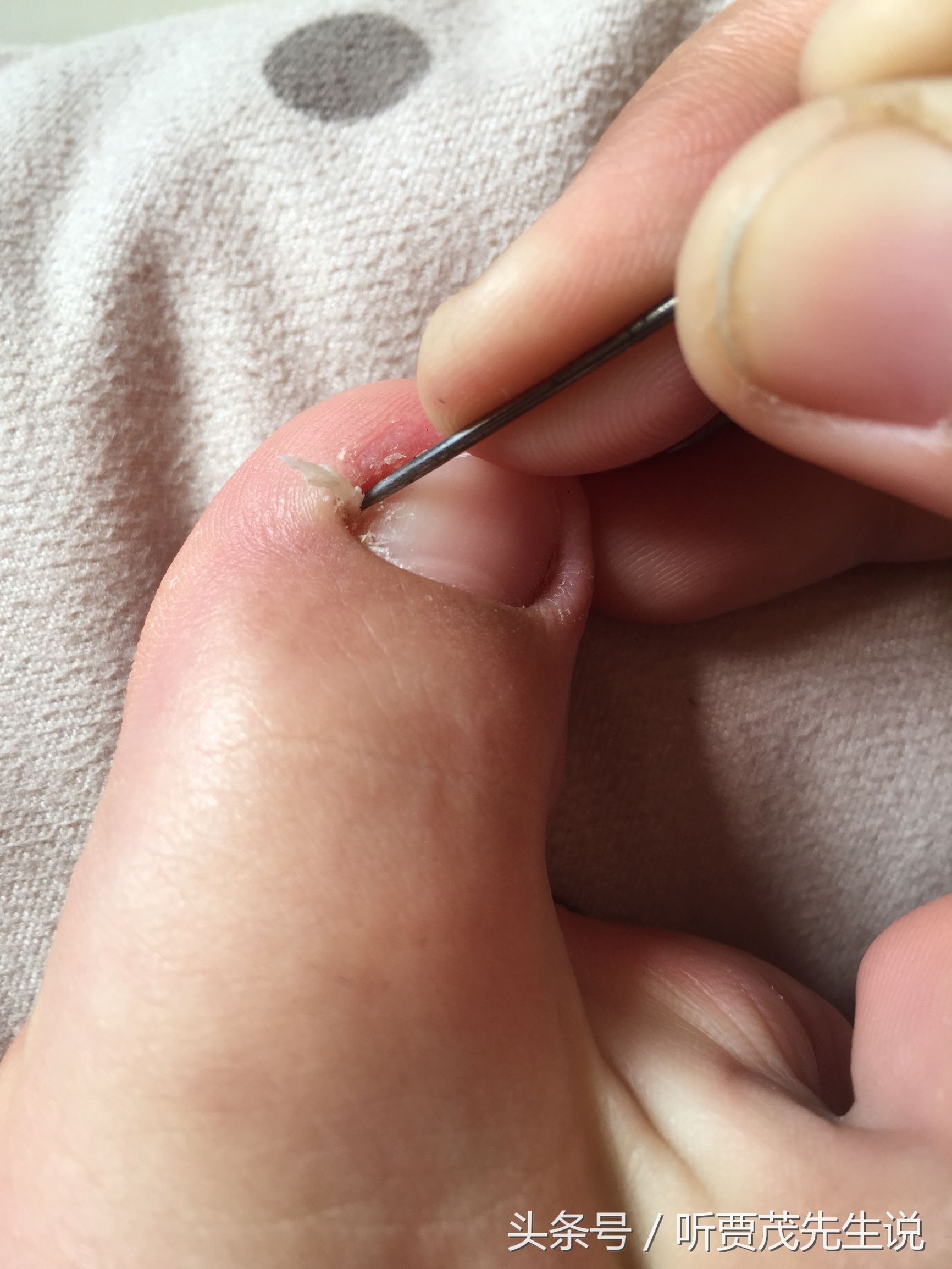 脚趾甲长进肉里什么原因,脚趾甲长进肉是怎么回事