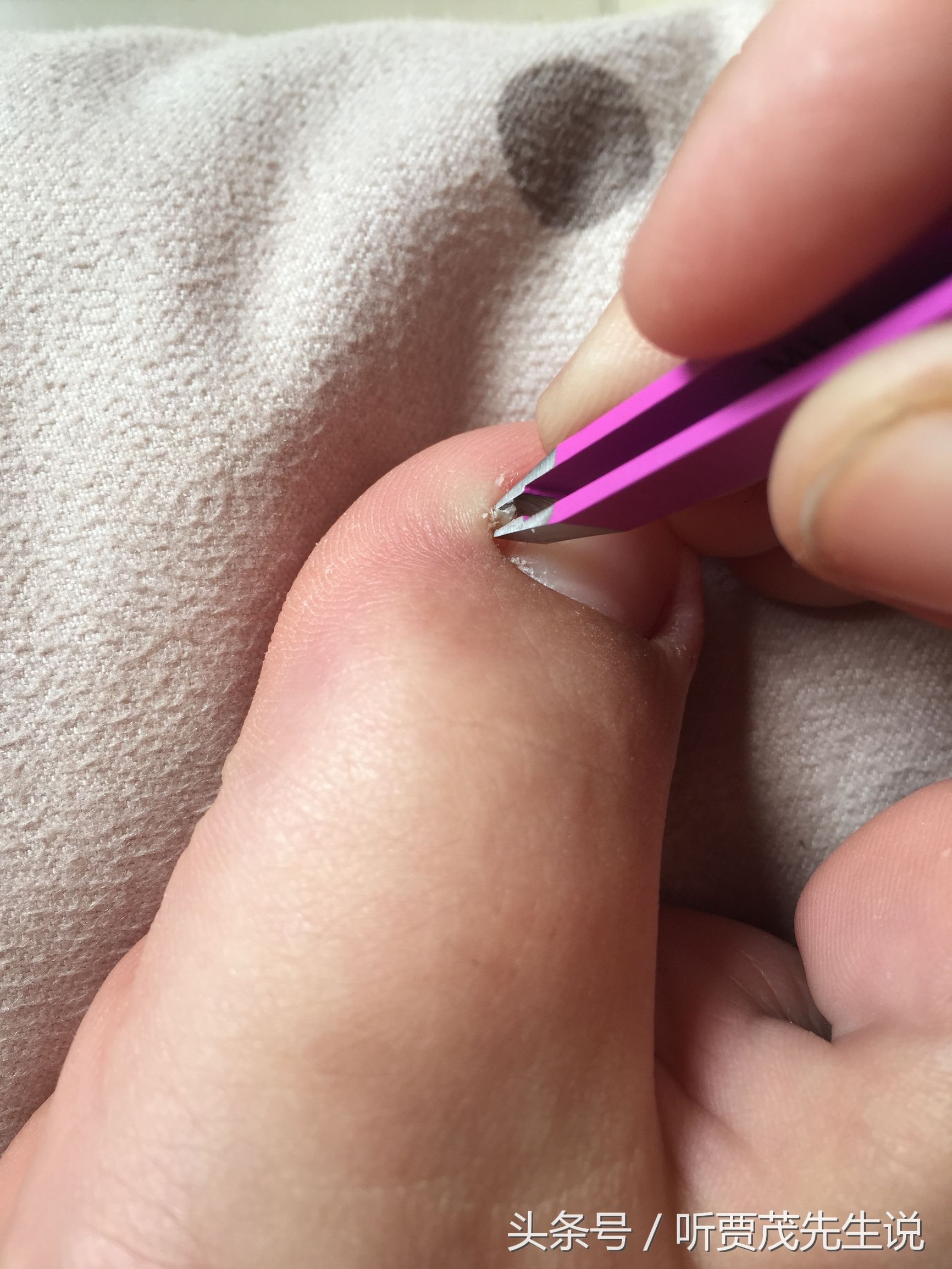 脚趾甲长进肉里什么原因,脚趾甲长进肉是怎么回事