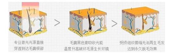 激光脱毛要脱几次才干净,激光脱毛脱唇毛几次脱干净