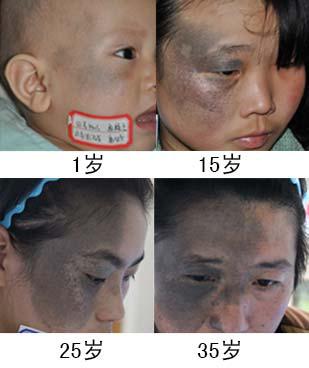 为什么胎记除不了根,为什么胎记不能被别人看见