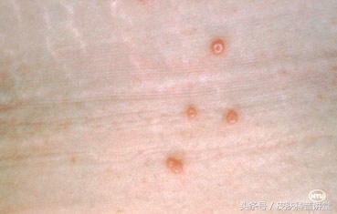 小孩传染性软疣冷冻后变成了水泡,儿童常见皮肤病疣