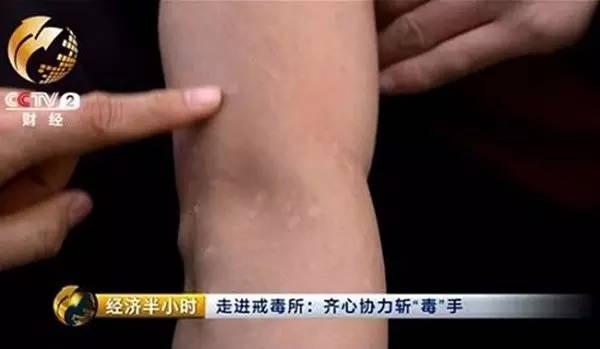 毒烟过敏怎么办,使用狼毒皮肤过敏