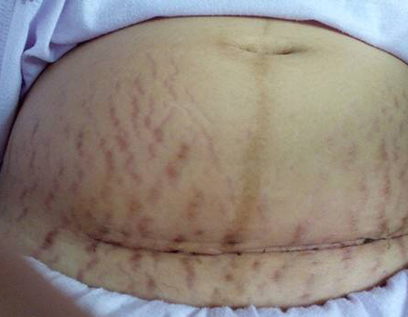 女人剖腹产之后腰疼,女人剖腹产之后的文案