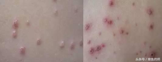 当心传染病暴发,注意到了冬季传染病高发期