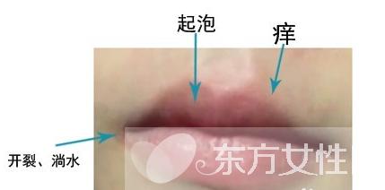 嘴上经常上火起泡什么原因,嘴上起泡是什么原因该怎么治疗