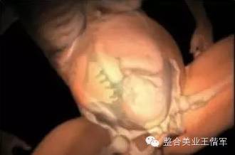 拒绝产后大肚腩轻轻松松搞定,盆腔臀疗手法