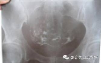 拒绝产后大肚腩轻轻松松搞定,盆腔臀疗手法
