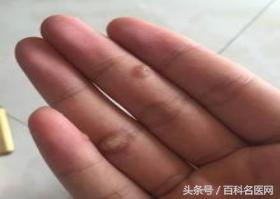 别尴尬!有这些典型症状就是尖锐湿疣了!专家说这样治疗不留疤