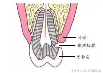 说清楚到底是什么意思,有几种原因引起牙疼
