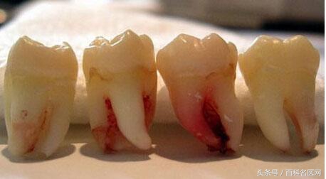 智齿一定要拔吗搞笑,智齿到底要不要拔掉会伤肾吗