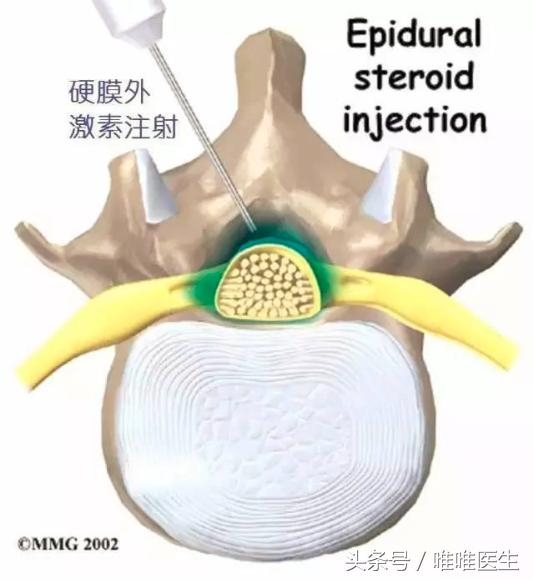 腰椎管狭窄保守治疗怎么治疗,老年腰椎管狭窄的保守治疗法