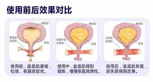 产后打喷嚏漏尿怎么办,产后打喷嚏漏尿怎样改善