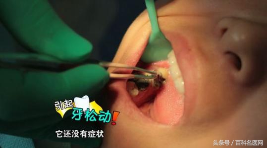 智齿一定要拔吗搞笑,智齿到底要不要拔掉会伤肾吗