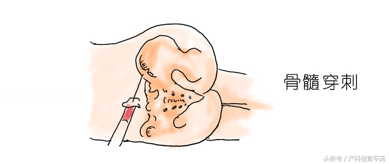 怀孕了有点贫血怎么办,怀孕缺铁性贫血