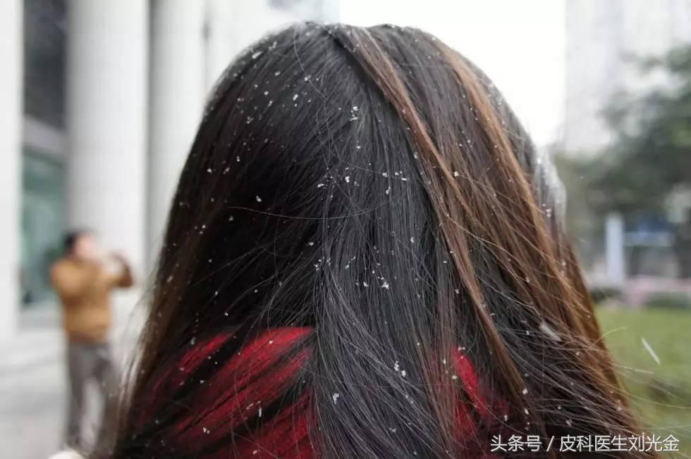 头皮屑多是不是缺少维生素b2,头皮屑多是不是皮肤病
