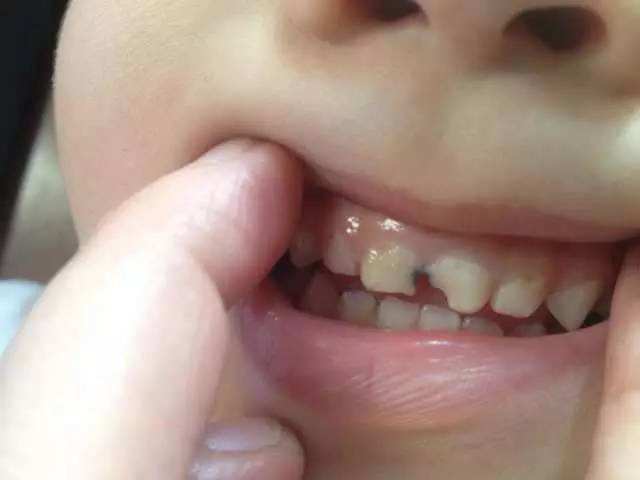 育儿专家说奶瓶龋的危害有哪些,宝宝为何会形成奶瓶性蛀牙