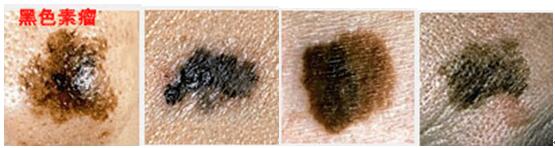 脸上肉痣可以随便切除吗,脸上的痣不能随便切吗