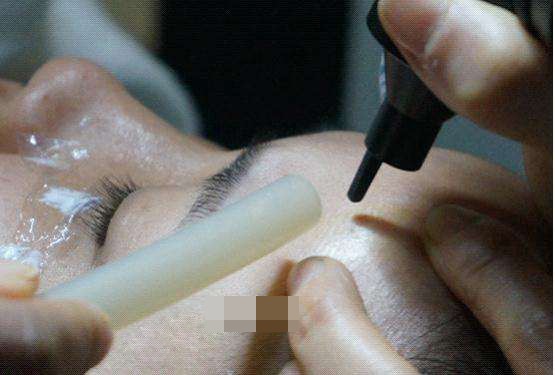 脸上肉痣可以随便切除吗,脸上的痣不能随便切吗