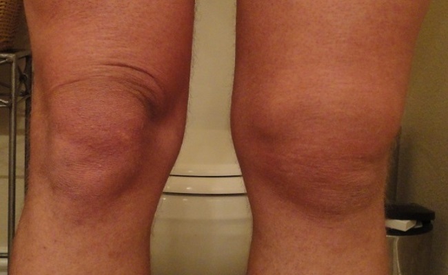 手掌红斑肝脏问题,手掌红眼睛红