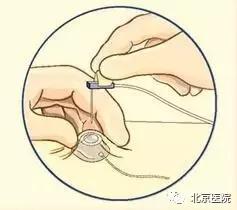 京医科普|输液港:放心化疗,安心停靠!