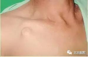 京医科普|输液港:放心化疗,安心停靠!