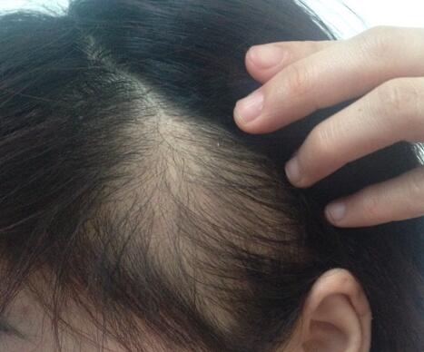 秃顶重新长头发太细怎么改善,秃顶头发稀少怎样掩饰