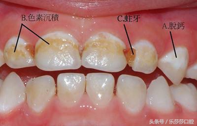 蛀牙会散发臭味吗,抠蛀牙洞臭