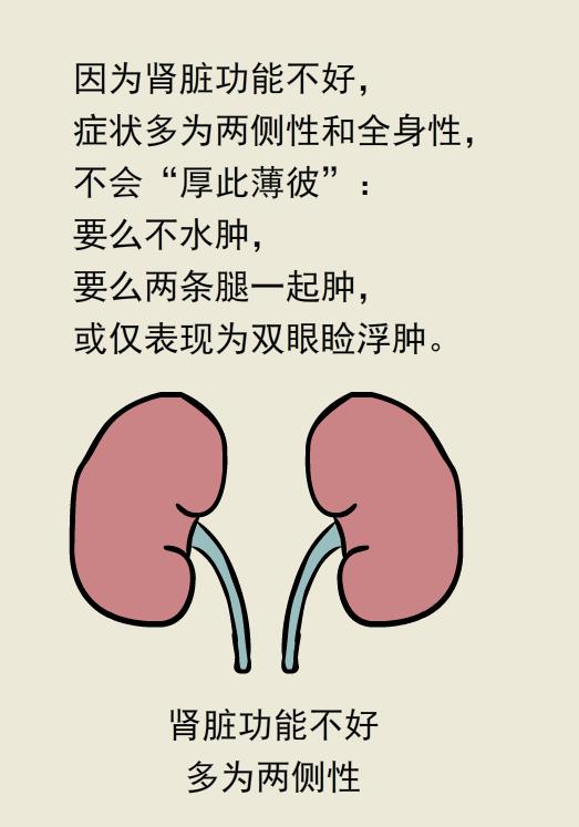 单腿肿和双腿肿的区别,两条腿肿的程度不一样