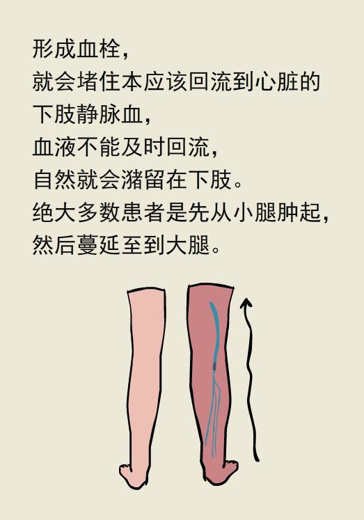 单腿肿和双腿肿的区别,两条腿肿的程度不一样