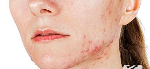 祛除痘印痘坑最好的方法,天然维生素e祛除痘印有效果吗