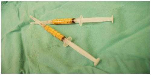 脂肪可以隆鼻么,脂肪隆鼻的最佳方法