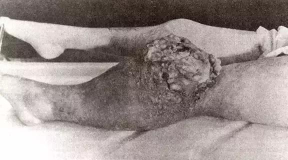 这种物质曾被当作保健成分,受害者的遗骨因此发光上千年