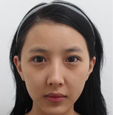 眼袋对形象影响有多大？看看你就都知道了！