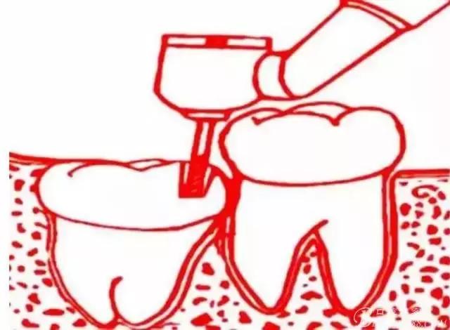 智齿的治疗过程,智齿要上下成对拔除吗