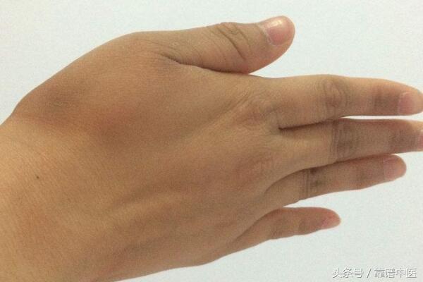 手肿之后要怎么办,输液后手又肿又痒