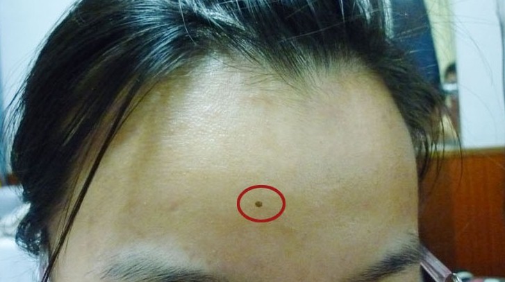 脸上肉痣可以随便切除吗,脸上的痣不能随便切吗