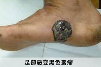 为什么胎记除不了根,为什么胎记不能被别人看见