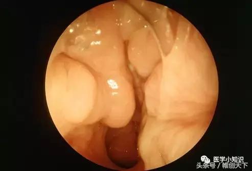 鼻窦炎引起头痛怎么治疗,鼻窦炎的症状及食疗视频播放