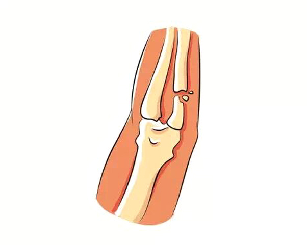 宝宝骨折了如何急救,宝宝骨折恢复过程中的四大禁忌