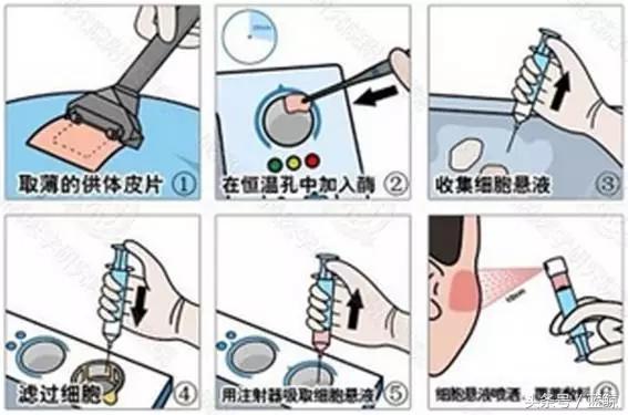 白癜风面积很大怎么办啊,多大面积的白癜风可以植皮