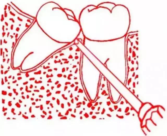 智齿的治疗过程,智齿要上下成对拔除吗