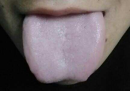 祛除脾湿的最好方法,脾湿要吃什么中成药才不上火