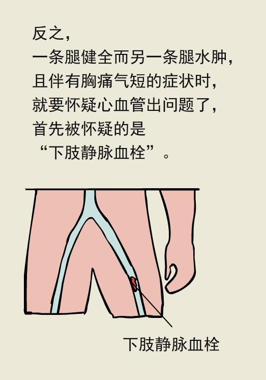 单腿肿和双腿肿的区别,两条腿肿的程度不一样