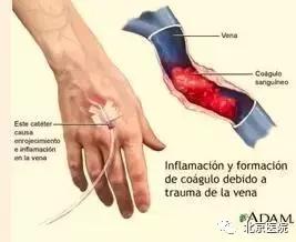 京医科普|输液港:放心化疗,安心停靠!